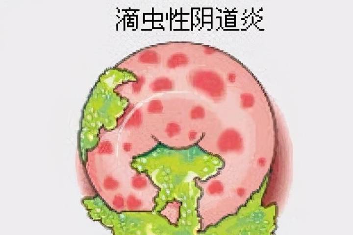 滴虫.jpeg