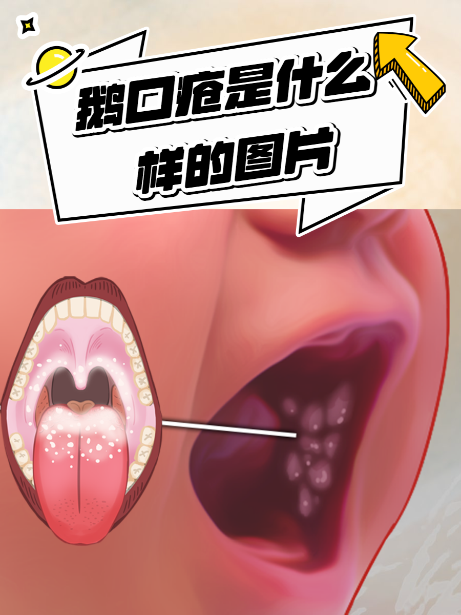 鹅口疮.png