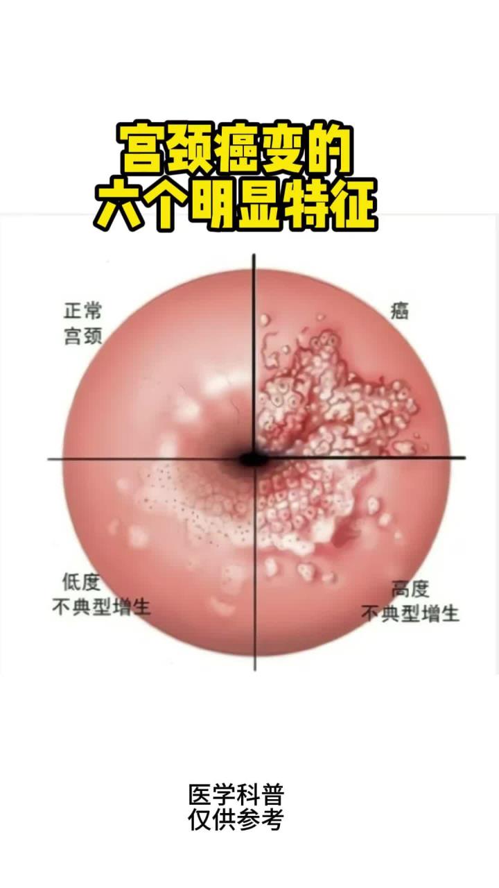湿疣.jpeg 湿疣.jpeg
