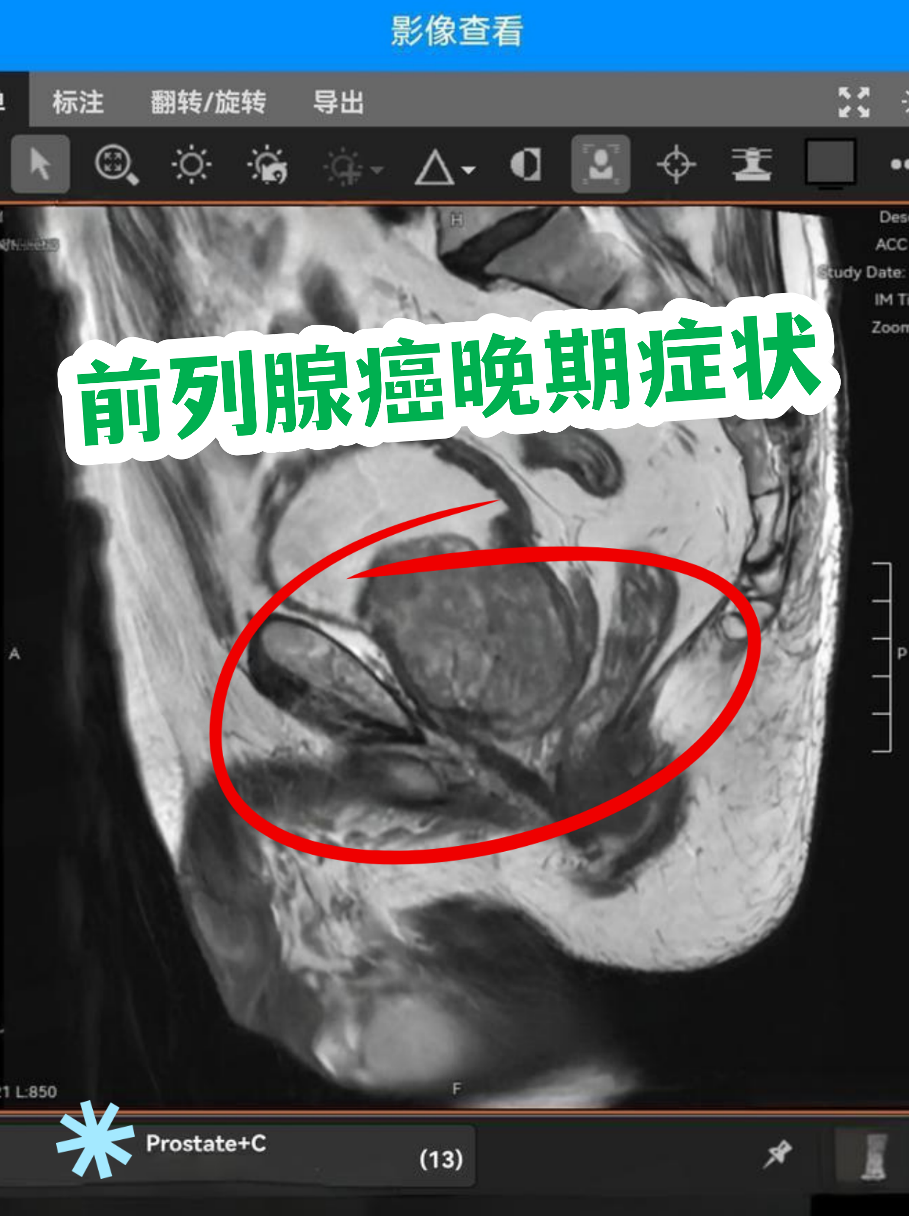 前列腺癌.png
